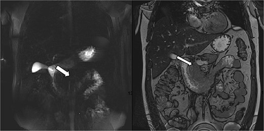 Magnetic Resonance Cholangiopancreatography (MRCP) axial image showing a T2-weighted hyperintense, thickened duodenal wall with cystic changes. The pancreatic duct and common bile duct appear normal without evidence of stones or significant dilation, supporting a diagnosis of groove pancreatitis over biliary pathology