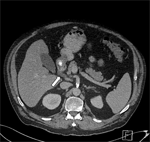 Axial contrast-enhanced CT scan of the abdomen at the level of the pancreatic head. The image demonstrates focal inflammatory fat stranding and soft tissue thickening within the pancreaticoduodenal groove, specifically localized between the second part of the duodenum and the uncinate process of the pancreas, without a discrete mass or vascular encasement.