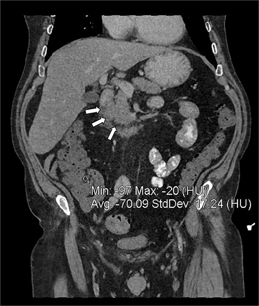 Coronal CT reconstruction of the abdomen showing the relationship between the pancreas and duodenum. White arrows highlight focal inflammatory fat stranding and soft tissue thickening within the pancreaticoduodenal groove, located between the second part of the duodenum and the uncinate process of the pancreatic head.