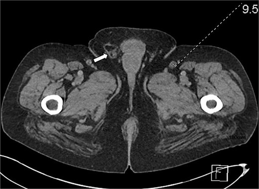 Axial CT scan of the lower pelvis showing a right-sided inguinal hernia. A white arrow points to a focal protrusion of mesenteric fat through the inguinal canal, situated lateral to the pubic tubercle, with no evidence of bowel entrapment or strangulation.
