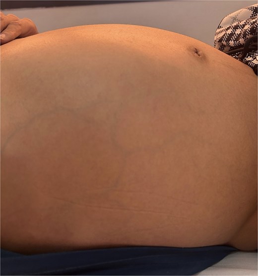 Important abdominal distension.