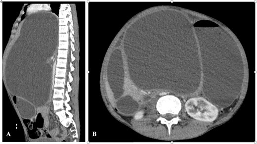 CT abdomen—(A) sagittal section and (B) axial section showing the pseudocyst with significant organ compression.