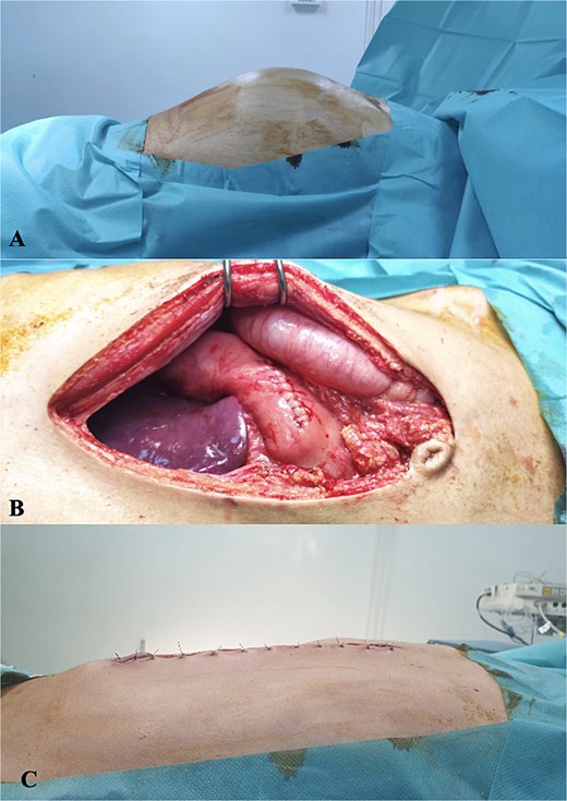 (A) Preoperative distension of the abdomen, (B) anastomosis of posterior wall of stomach and cyst wall, and (C) postoperative outcome.