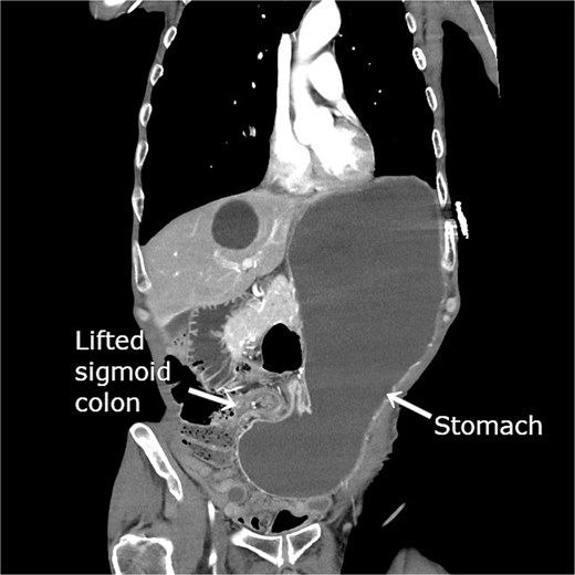 Contrast-enhanced CT image showing herniation of the stomach through the lateral defect between the lifted sigmoid colon and the abdominal wall. The elevated sigmoid colon compresses the pyloric region from the right side, resulting in focal narrowing near the antrum and marked gastric dilatation with fluid retention.