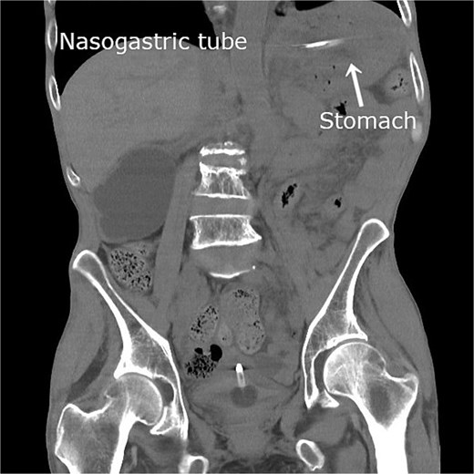 Follow-up plain computed tomography obtained the day after admission showing resolution of gastric dilatation after nasogastric decompression. The stomach has returned to its normal anatomical position, indicating spontaneous reduction of the internal hernia.