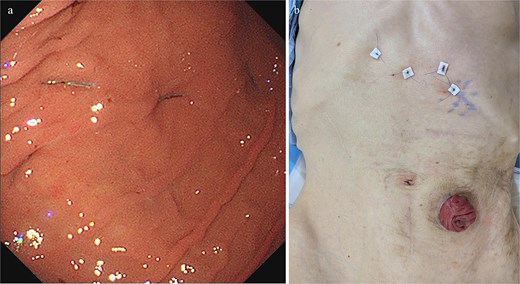 (a) Upper gastrointestinal endoscopic view after percutaneous endoscopic gastropexy showing four-point gastric fixation at the anterior wall of the mid-gastric body and the angular incisure, involving both the greater curvature and anterior surface.(b) External abdominal photograph after the procedure demonstrating the corresponding four gastric fixation sites.
