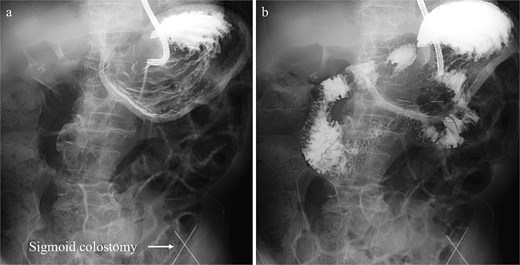 (a) Fluoroscopic image from a gastrografin contrast study immediately after percutaneous endoscopic gastropexy showing the stomach in its normal anatomical position with sufficient separation from the sigmoid colostomy.(b) Fluoroscopic image demonstrating smooth passage of the contrast medium from the stomach through the duodenum into the small intestine.