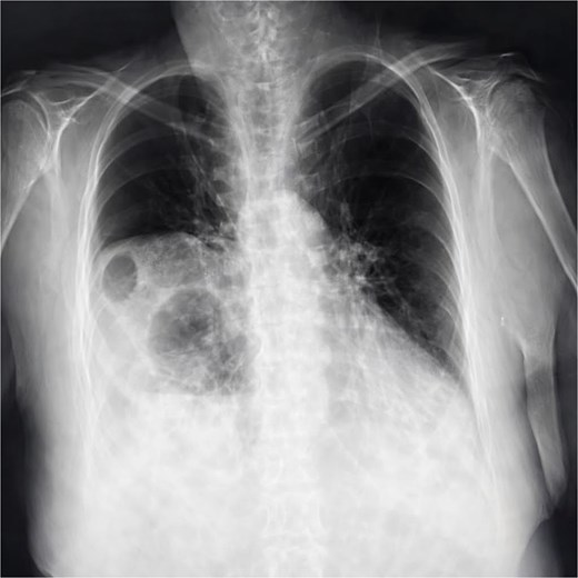 Chest X-ray showing elevation of the right diaphragmatic cupola, eventration (blue arrow), obliteration of the left subdiaphragmatic recess and sub diaphragmatic colonic air fluid level.