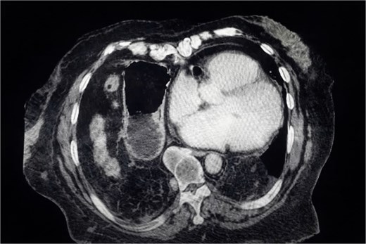 CT scan showing a large right anterolateral diaphragmatic hernia with a maximal craniocaudal extent.