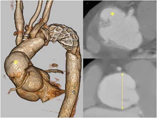 Preoperative computed tomography showing an aortic root aneurysm with a proximal pseudoaneurysm adjacent to the ascending aorta.