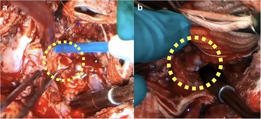 Intraoperative findings showing (a) trimming of the left coronary artery to the left main trunk due to dissection, and (b) reconstruction using a short saphenous vein graft interposition between the left main trunk and the neo-aortic root.