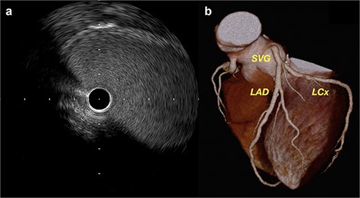 Postoperative imaging showing (a) intravascular ultrasound demonstrating a widely patent saphenous vein graft without stenosis, and (b) follow-up computed tomography at 6 months confirming good graft patency and configuration.