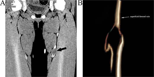 CT images before the operation revealed a 2 times 1 cm nodule soft mass in the left thigh of the patient and the superficial femoral vein was compressed by it.