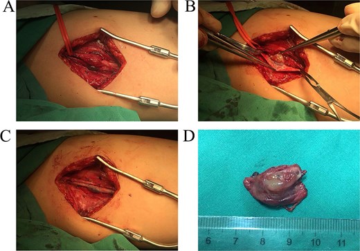 (A) During the operation, the tumor was found located between the superficial femoral vessels and closely adhering to them. (B) The tumor could not be separated from the superficial femoral vein because of dense adhesion and the tumor can be found inside the affected venous. (C) The superficial femoral vein was reconstructed by a venous patch after the tumor and part of the vessel wall were resected. (D) The tumor measured about 20 mm in greatest diameter and the venous wall was infiltrated.
