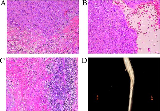 (A-C) HE staining revealed typical characteristic of AFH: nests of round, oval histiocyte-like cells; pseudovascular blood filled spaces without endothelial cells lining; lymphocytes infiltration and fibrous pseudocapsule. (D) CT angiography showed that the superficial femoral vein kept patent without stenosis one year after the operation.
