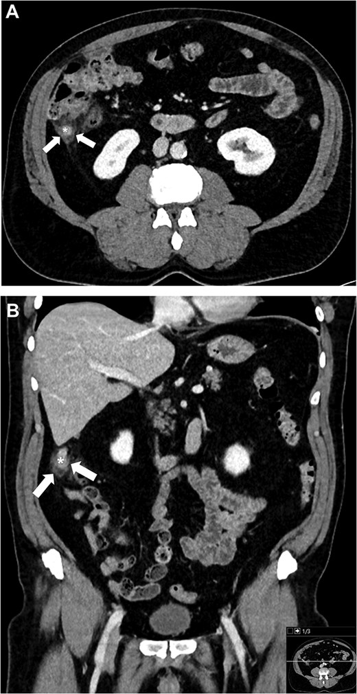 Contrast-enhanced CT showing an inflamed appendix with periappendiceal fat stranding.