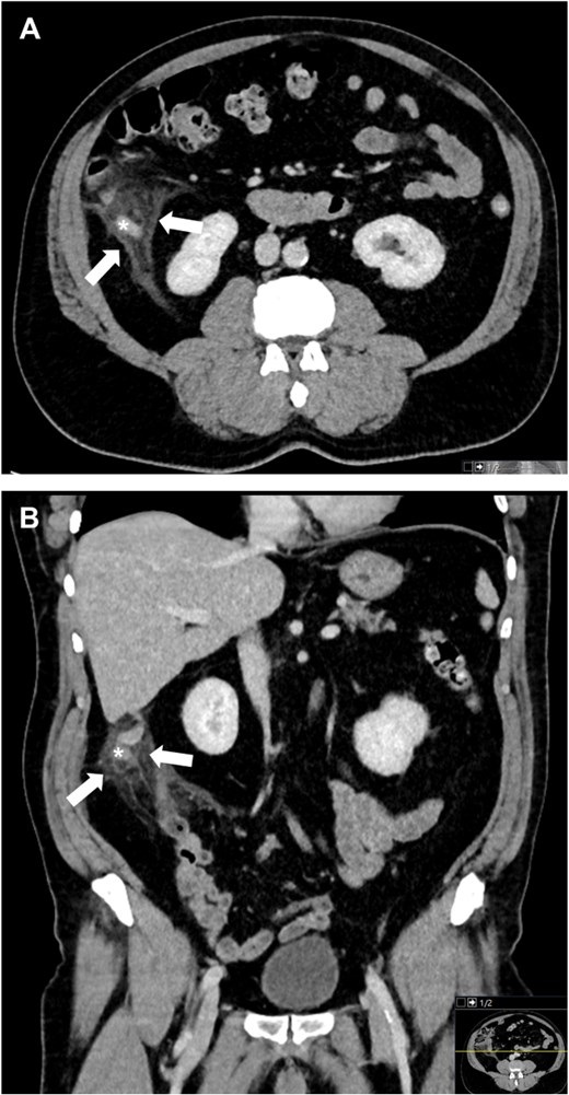Contrast-enhanced CT showing recurrent appendicitis with appendiceal thickening and periappendiceal fat stranding.