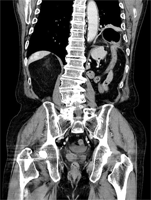 Coronal CT images using contrast agent show that the transverse colon has herniated into the left thoracic cavity through a diaphragmatic defect on the left side, but there are no signs of intestinal strangulation.