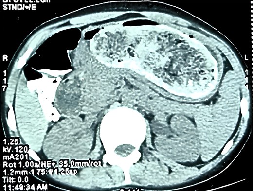 Axial CT scan of the abdomen showing the trichobezoar within the stomach/intestine.