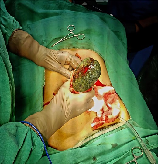 Intraoperative photograph showing the surgical extraction of trichobezoar through gastrotomy incision.