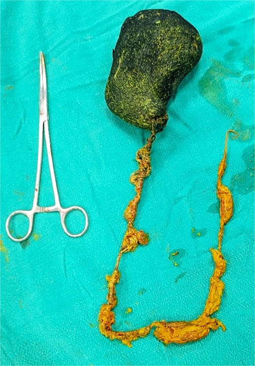 Photograph of the fully extracted trichobezoar, showing thick, consolidated hairball with a long, thin tail like extension that occupied the small intestine.