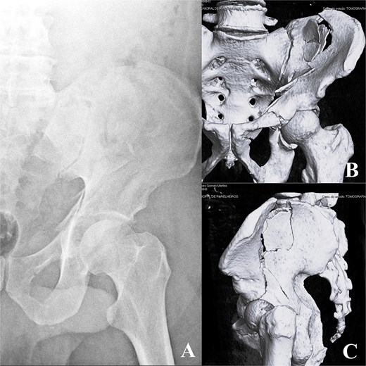 Image A (left - radiograph): ``Anteroposterior pelvic radiograph demonstrating a complex fracture of the right hemipelvis, with disruption of the iliac wing and acetabular region; the femoral head remains aligned within the acetabulum, without obvious dislocation. Image B (top right - 3D CT): ``Threedimensional CT reconstruction of the pelvis showing a comminuted fracture of the right iliac wing with extension into the acetabulum, associated with displacement of fracture fragments and involvement of the pelvic ring.'' Image C (bottom right - 3D CT): ``Lateral three-dimensional CT view of the right hemipelvis demonstrating a multifragmentary iliac and acetabular fracture, with significant cortical disruption and displacement, without clear femoroacetabular dislocation.''