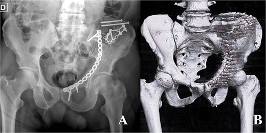 Image A (left - postoperative radiograph): ``Anteroposterior pelvic radiograph demonstrating postoperative fixation of a right hemipelvic fracture, with reconstruction plates and multiple screws along the iliac wing and anterior column, restoring pelvic ring alignment and acetabular congruity.'' Image B (right - 3D CT): ``Threedimensional CT reconstruction of the pelvis showing internal fixation of a right iliac and acetabular fracture with plates and screws, demonstrating improved alignment of the iliac wing and pelvic ring with residual cortical irregularity at the fracture site.''