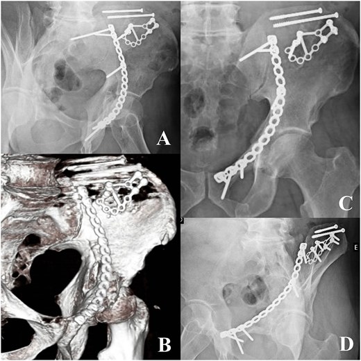 Image A (top left - radiograph): ``Oblique pelvic radiograph demonstrating postoperative fixation of a right iliac wing and acetabular fracture with reconstruction plates and multiple screws, including supra-acetabular screw placement and anterior column stabilization.'' Image B (bottom left - 3D CT): ``Threedimensional CT reconstruction of the right hemipelvis showing internal fixation with a contoured reconstruction plate along the iliac wing extending to the anterior column, with multiple screws securing a previously comminuted fracture.'' Image C (top right - radiograph): ``Anteroposterior pelvic radiograph demonstrating maintained alignment of the right hemipelvis following internal fixation, with reconstruction plate along the pelvic brim and screws across the iliac wing and acetabular region.'' Image D (bottom right - radiograph): ``Oblique pelvic radiograph showing stable postoperative fixation of the right iliac and acetabular fracture, with appropriate positioning of plates and screws and preservation of hip joint congruity.''