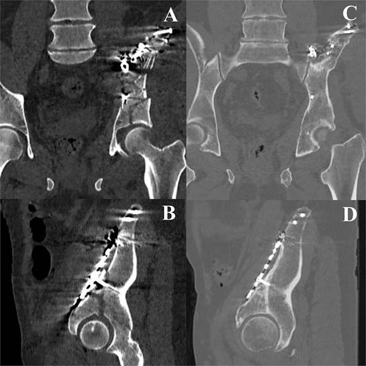 Image A (top left - coronal CT, postoperative): ``Coronal CT image of the pelvis demonstrating internal fixation of a right iliac and acetabular fracture with plate and screws bridging the fracture site and restoring pelvic continuity..'' Image B (bottom left - sagittal CT, postoperative): ``Sagittal CT reconstruction showing fixation along the right iliac wing and anterior column, with a contoured plate and multiple screws bridging the fracture site and restoring pelvic continuity.'' Image C (top right - coronal CT, preoperative): ``Coronal CT image demonstrating a comminuted fracture of the right iliac wing with extension into the acetabulum, with improved cortical continuity and maintained of pelvic ring.'' Image D (bottom right - sagittal CT, postoperative): ``Sagittal CT reconstruction demonstrating postoperative alignment of the right hemipelvis following plate fixation, with improved cortical continuity and maintained hip joint congruity.''