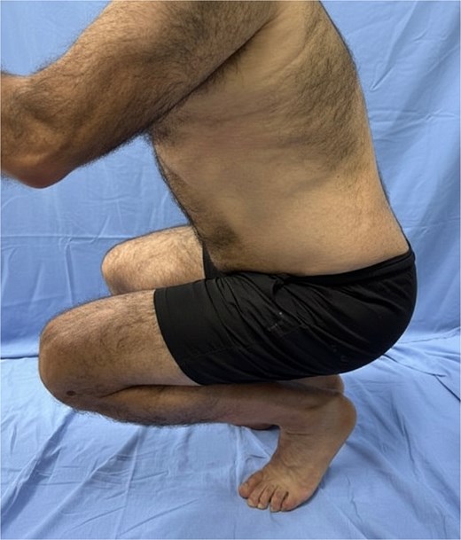 Lateral view of an adult patient in a deep squat position, demonstrating marked limitation of hip flexion with compensatory posterior pelvic tilt and trunk flexion, suggestive of restricted hip range of motion.