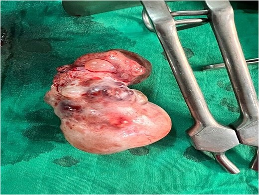 Macroscopic photograph of a surgical specimen following left salpingo-oophorectomy. The specimen shows a large, solid, multilobulated ovarian mass with an intact external capsule and areas of surface hemorrhage. The mass has an irregular, bumpy outline, a light beige to brownish color, and dark red hemorrhagic foci distributed across its entire external surface.