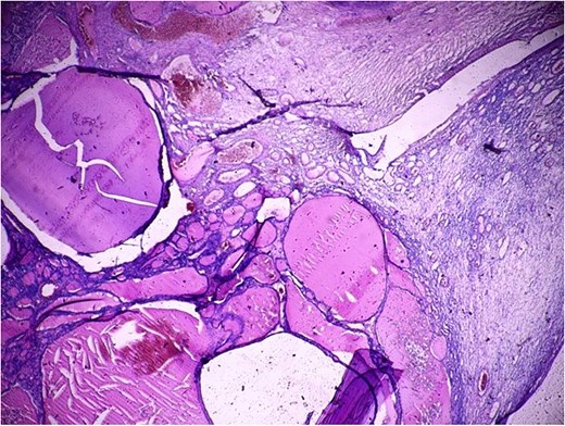 Photomicrograph of a hematoxylin-eosin stained histopathological section at low magnification (×40), showing multiple thyroid follicles of varying sizes filled with eosinophilic colloid and lined with flattened to cuboidal follicular epithelium, all embedded in ovarian stroma. The follicular architecture occupies more than 50% of the tumor volume, which is consistent with the diagnosis of struma ovarii.