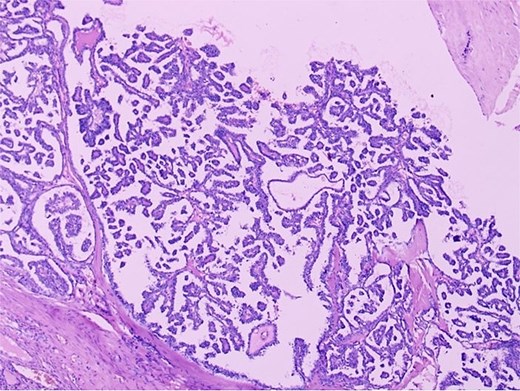 Photomicrograph of a hematoxylin-eosin-stained histopathological section at high magnification (×100), showing papillary thyroid carcinoma arising within struma ovarii. The image reveals complex papillary fronds with a fibrovascular core, lined with neoplastic follicular cells exhibiting the nuclear features typical of papillary thyroid carcinoma: enlarged and overlapping nuclei, nuclear clearing, and irregular nuclear contours. Benign thyroid follicles filled with colloid are visible in the left portion of the image, illustrating the transition between malignant and nonmalignant thyroid tissue within the ovarian tumor.