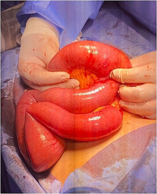 In Figure 1, a terminal ileal segment is shown with an intraluminal mass causing proximal dilatation, along with an edematous intestinal loop and obstruction of luminal content progression.