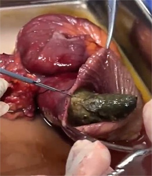 Figure 2 shows a longitudinal opening of the resected ileal segment, revealing a soft intraluminal mass with elongated morphology and foul odor, consistent with a retained surgical sponge (gossypiboma).
