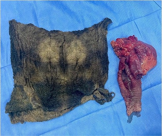 Figure 3 shows a surgical dressing sponge extracted after intestinal resection, displayed on a sterile field; to the right, the affected ileal segment demonstrates thickened serosa and dense surrounding adhesions.