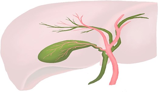 Anatomical illustration showing normal gallbladder anatomy, including the cystic duct and cystic artery, demonstrating typical fixation of the gallbladder to the liver bed.
