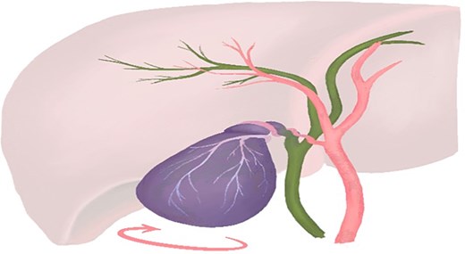 Schematic illustration depicting gallbladder volvulus, showing clockwise rotation of the gallbladder around its mesentery with resultant vascular compromise.