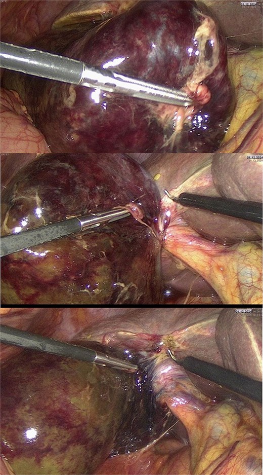 Intraoperative photographs showing gallbladder volvulus findings:(a) distended, gangrenous gallbladder with tense, violaceous wall indicating ischemia; (b) clockwise volvulus of the gallbladder around the cystic duct and artery, consistent with a floating gallbladder; (c) appearance after detorsion, with restored anatomical orientation before laparoscopic cholecystectomy.