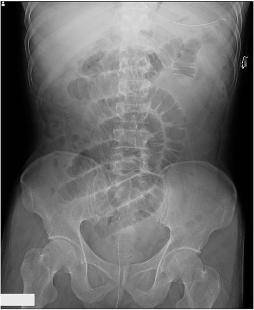 Abdominal radiograph showing dilated small bowel loops consistent with small bowel obstruction.