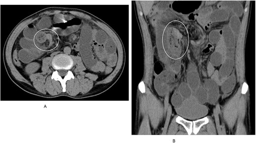 Axial CT image showing dilated small bowel loops with a small bowel feces sign in the right upper quadrant. Coronal CT image showing collapsed distal small bowel loops distal to the transition point, consistent with small bowel obstruction.