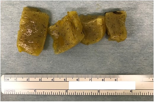 Intraoperative photograph showing four connected pieces of konjac removed from the small intestine through an enterotomy.