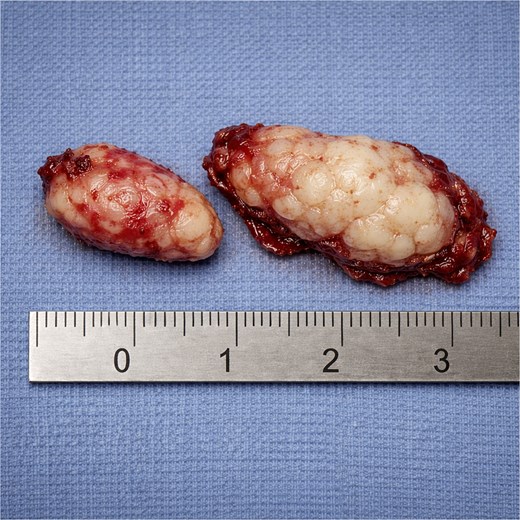 Gross specimen demonstrating irregular tan-pink fragments of mucosal and cartilaginous tissue measuring approx 2.0 and approx 2.5 cm.