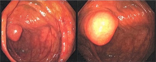 Two colonoscopy images of the cecum. In the left image, the appendiceal orifice is not visible; instead, a small, smooth, round mass protrudes into the cecal lumen from the wall. In the right image, with the scope advanced closer, the lesion appears larger and dome-shaped with a pale, rounded tip, consistent with an inverted appendix extending into the cecal lumen.