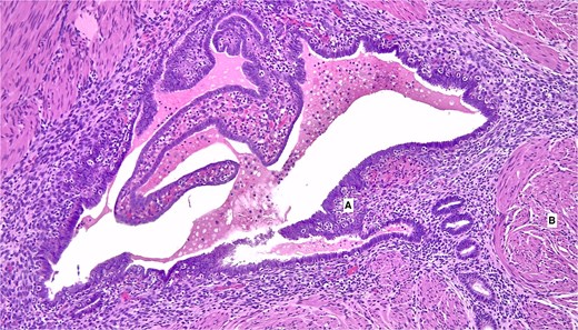 Histologic image of the appendiceal wall at 100 times magnification stained in pink and purple (H ampersand E). Irregular, gland-like structures lined by dark-staining epithelial cells are seen embedded within the wall, surrounded by dense cellular stroma, consistent with endometrial glands and stroma (labeled A) within the muscular layer. Adjacent areas (labeled B) show thickened bundles of smooth muscle, indicating fibromuscular hypertrophy.