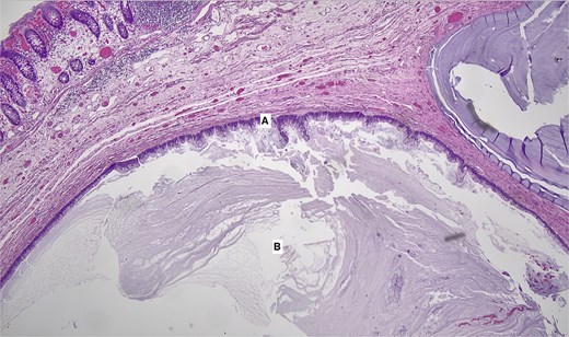 Low-power (40×) histologic image of the appendix stained in pink and purple (H&E). The appendiceal wall is expanded and lined by villous, finger-like projections of mucin-producing epithelial cells with relatively uniform, mildly atypical nuclei (labeled A), consistent with low-grade neoplasm. Beneath this lining, a large, dilated space (labeled B) is filled with pale, amorphous mucin, distending the lumen and pushing into the surrounding wall, characteristic of a low-grade appendiceal mucinous neoplasm (LAMN).
