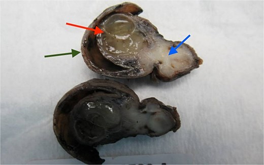 This gross pathology specimen of an appendectomy and partial cecectomy shows an appendix inverted into the cecum (indicated by a green arrow). The cross-section reveals a translucent, dilated mucinous adenoma (red arrow) and a dense area of white fibrotic tissue (blue arrow) consistent with endometriosis obstructing the appendiceal lumen.
