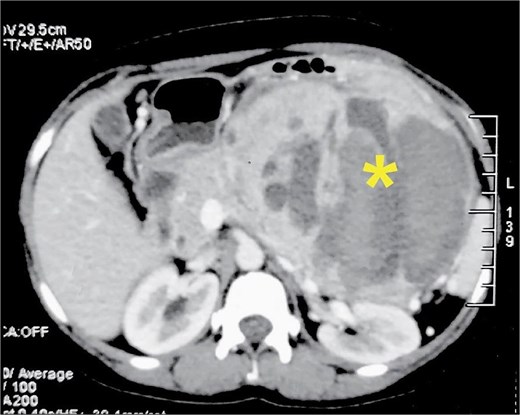 Alt Text: Axial CT scan of the abdomen displaying a massive, complex tumor in the pancreatic region. The mass appears mixed, with both bright (enhancing) solid areas and dark (cystic) fluid-filled areas. A yellow asterisk marks a central dark region indicating tissue necrosis.