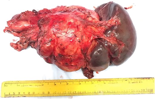 Alt Text: A gross pathology photograph showing a large, surgically resected tissue specimen on a white background. On the left and center is a bulky, nodular, reddish-fleshy tumor mass. Attached to the right side of the mass is a smooth, dark purple spleen. A ruler is positioned horizontally below the specimen to indicate size.