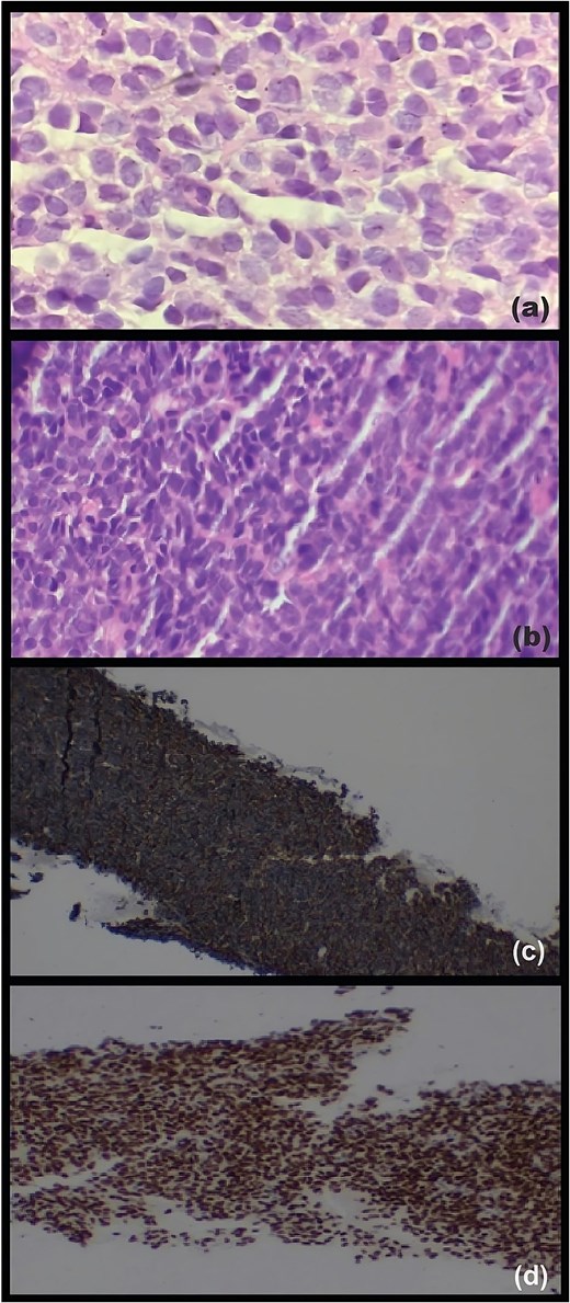 Alt Text: Composite figure consisting of four photomicrographs. (a) H&E stain of pancreatic tissue showing a dense population of small blue-stained cells with scant cytoplasm and pink (eosinophilic) secretions in cystic spaces. (b) H&E stain of liver tissue showing crowded, irregular blue cells with large nuclei. (c) CD99 immunohistochemistry showing diffuse brown staining outlining the cell membranes (membranous pattern). (d) NKX2.2 immunohistochemistry showing diffuse brown staining specifically within the cell nuclei (nuclear pattern).